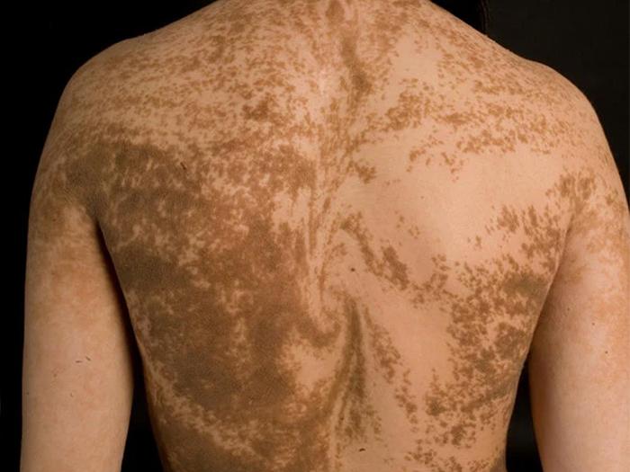 Dos féminin présentant des motifs en spirale de pigmentation plus foncée sur une peau claire.