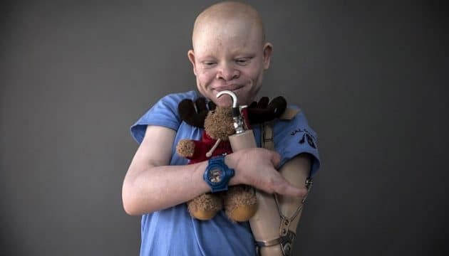 Chassés en Tanzanie à cause de leur albinisme, ces enfants retrouvent le sourire aux Etats-Unis albinos, persécution, mutilation, Tanzanie