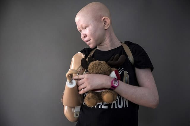 albinos, persécution, mutilation, Tanzanie